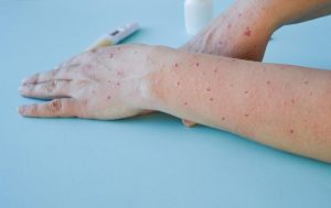 First monkeypox infection reported in India: could travel insurance help?